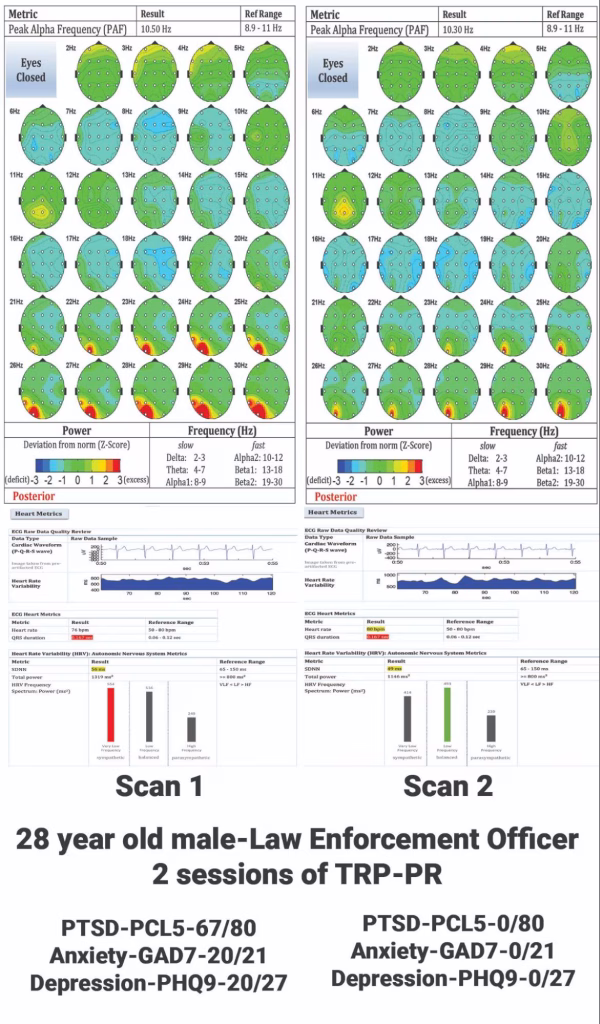 ASU Study, 2 session of TRP-PR